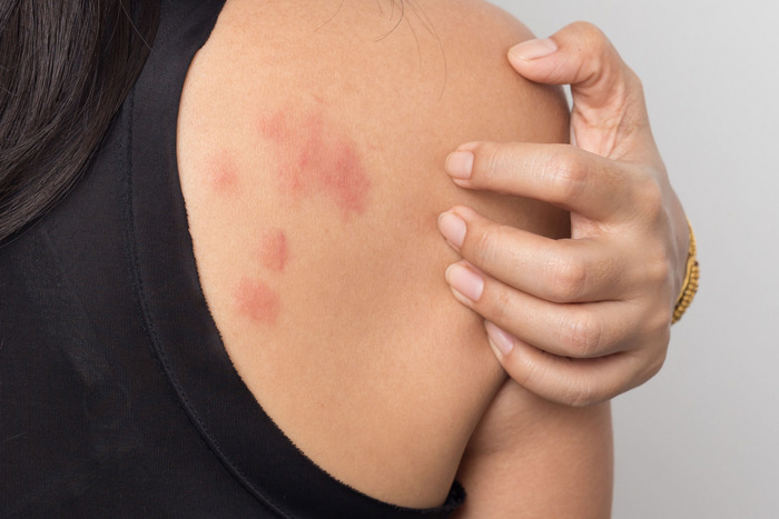 What to Do When Stress Gives You Hives - The American Institute of Stress